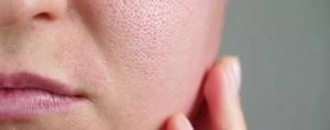 Ghid Complet pentru Tenul cu Pori Dilatați și Exces de Sebum