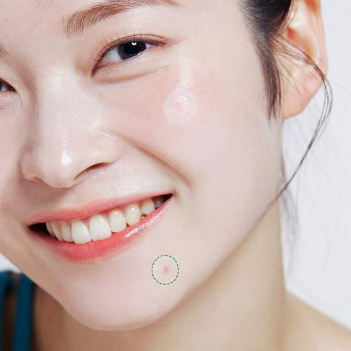 ACROPASS Trouble Care Microcone Patch Small - plasturi formulati cu niacinamide si Centella Asiatica (CICA), care contribuie la ingrijirea localizata a imperfectiunilor si la echilibrarea sebumului - 9 buc