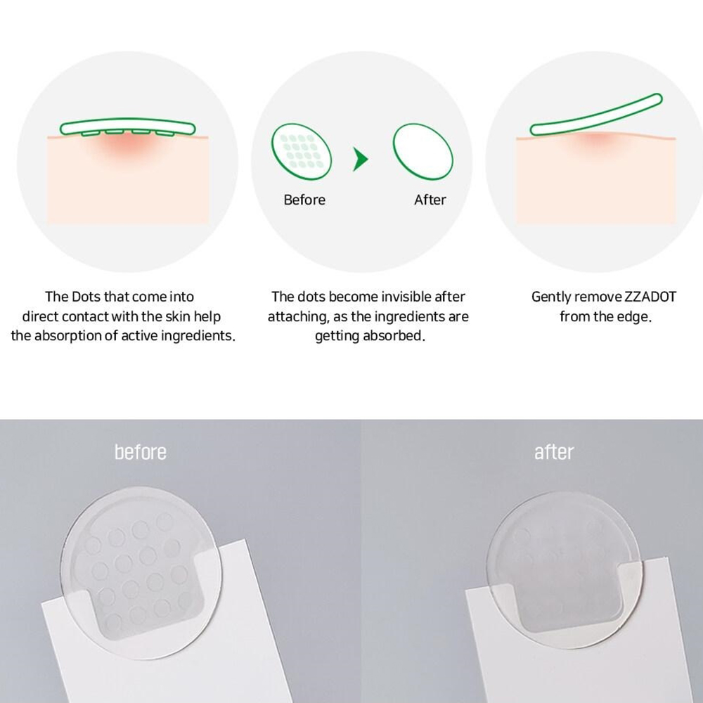 ZZA DOT Plasturi pentru acnee 45 buc